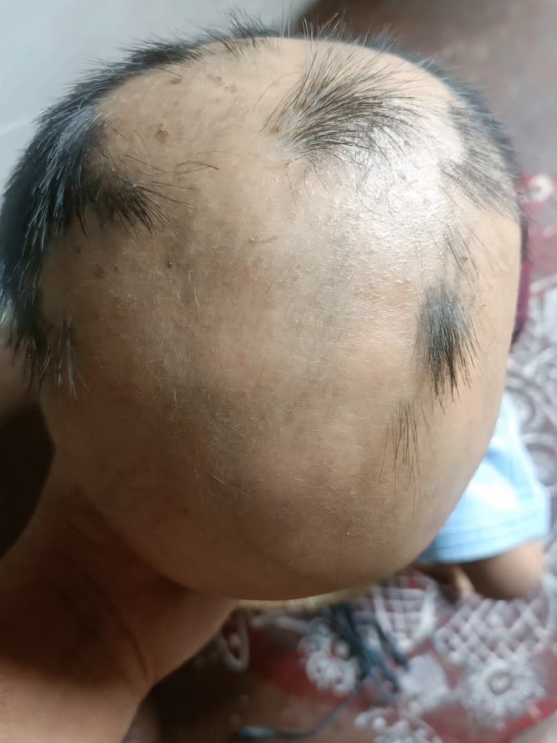 Before treatment for alopecia areata